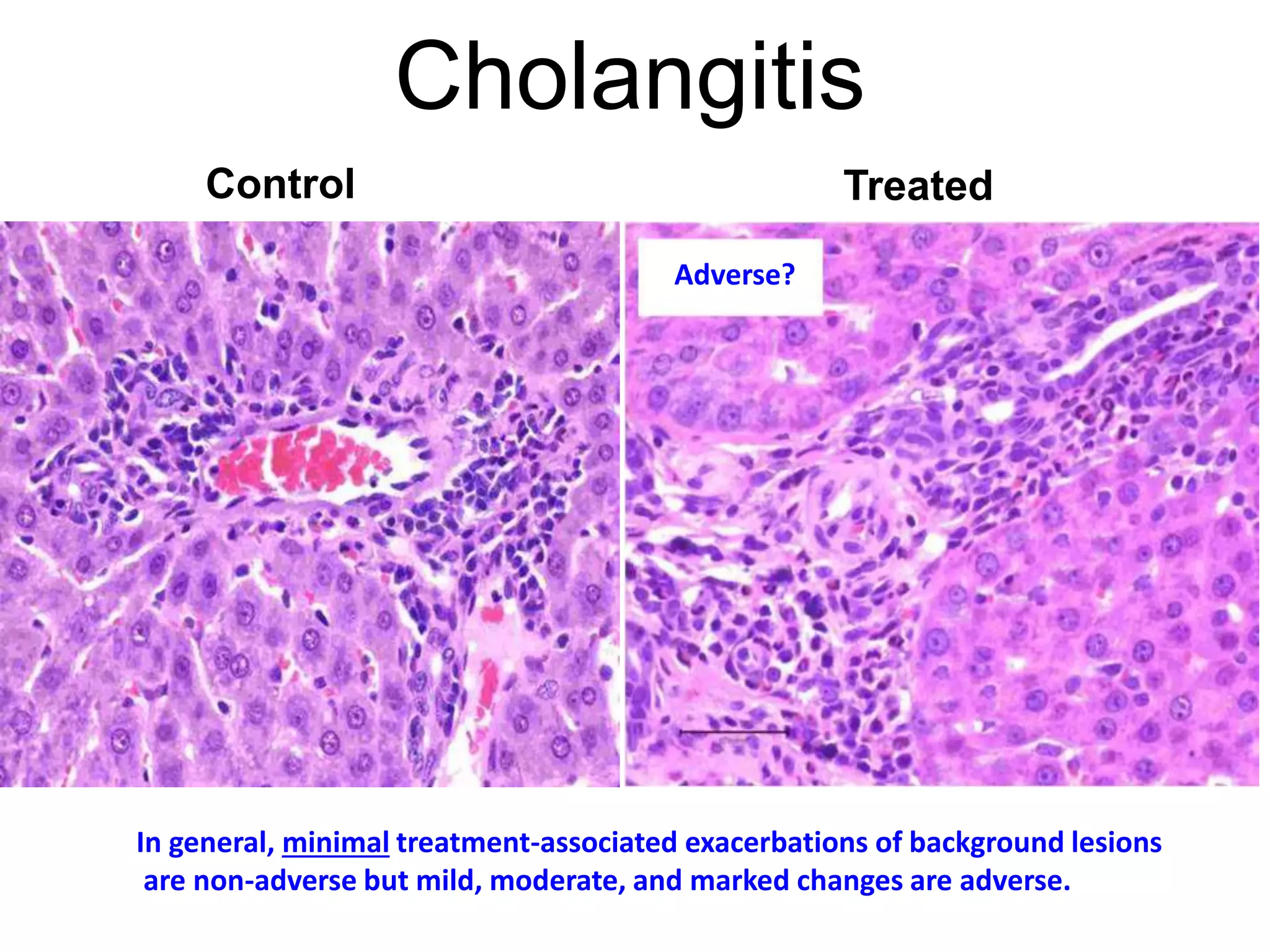 Cholangitis
Control Treated
Adverse?
In general, minimal treatment-associated exacerbations of background lesions
are non-adverse but mild, moderate, and marked changes are adverse.
 