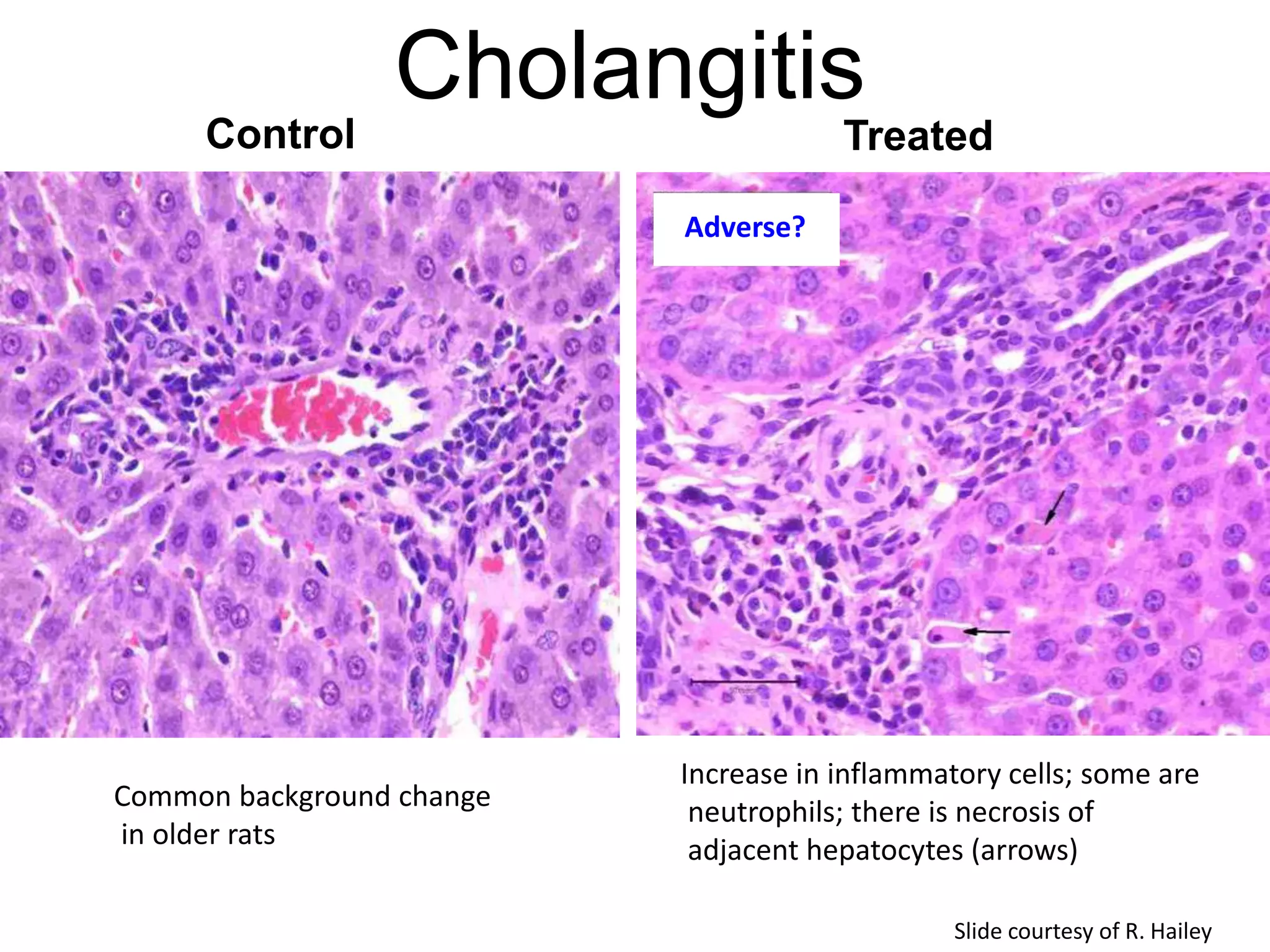 Cholangitis
Control Treated
Increase in inflammatory cells; some are
neutrophils; there is necrosis of
adjacent hepatocytes (arrows)
Common background change
in older rats
Slide courtesy of R. Hailey
Adverse?
 