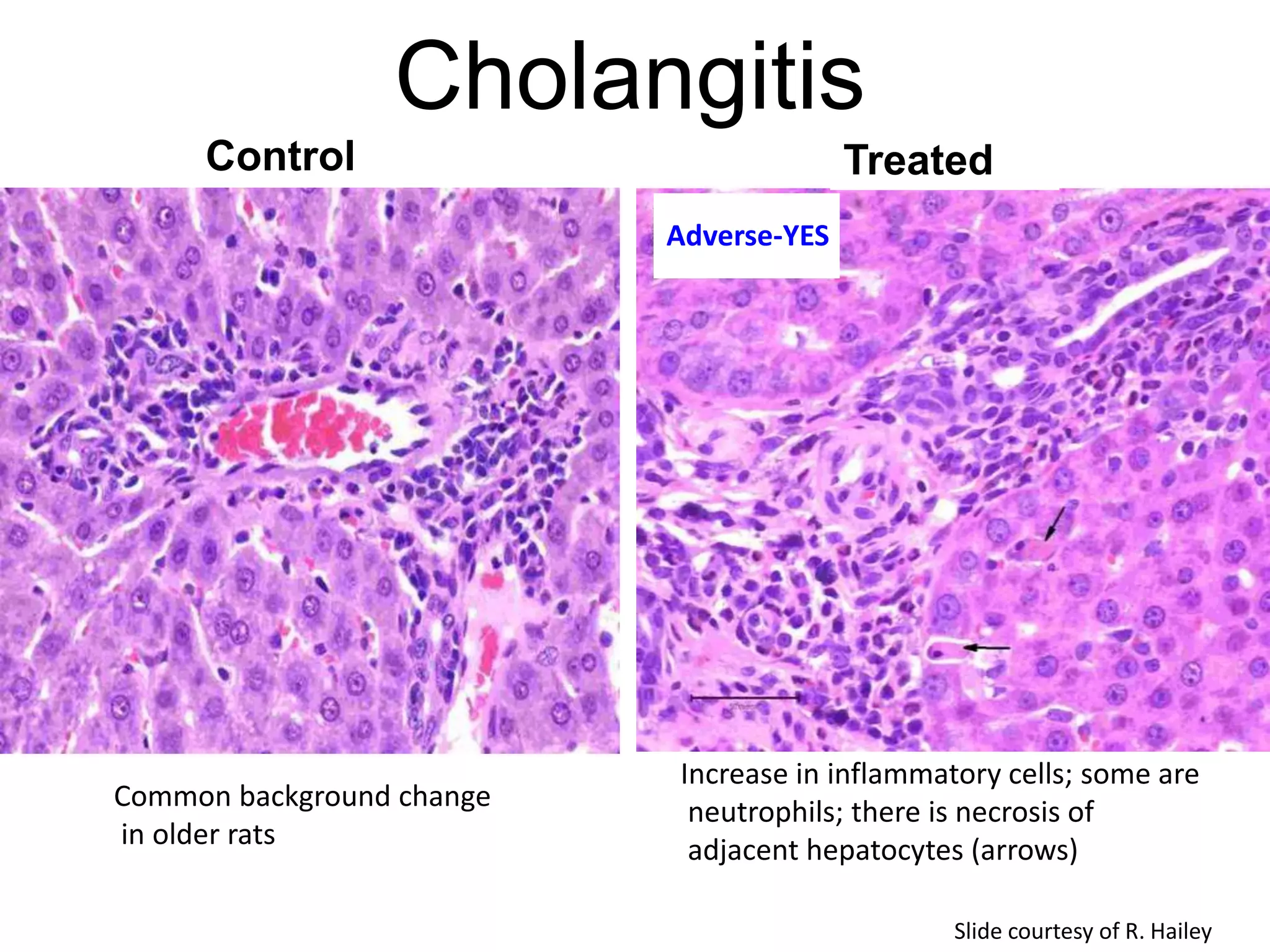 Cholangitis
Control Treated
Increase in inflammatory cells; some are
neutrophils; there is necrosis of
adjacent hepatocytes (arrows)
Common background change
in older rats
Slide courtesy of R. Hailey
Adverse-YES
 