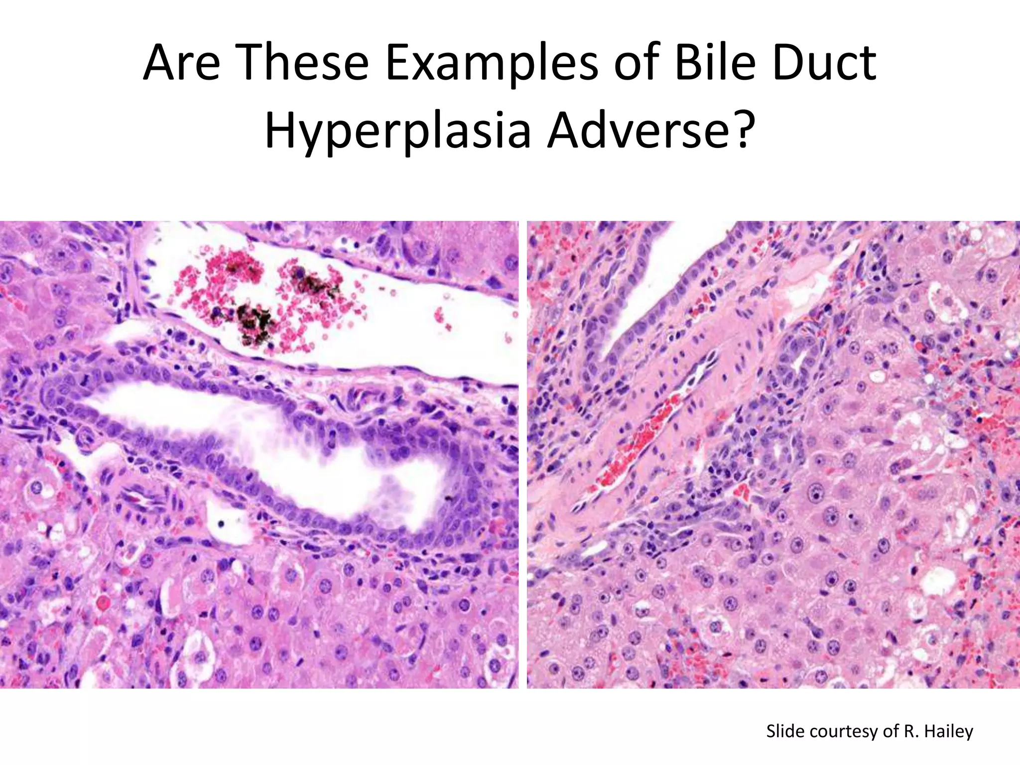 Biliary epithelial hyperplasia:
Adverse?
Are These Examples of Bile Duct
Hyperplasia Adverse?
Slide courtesy of R. Hailey
 