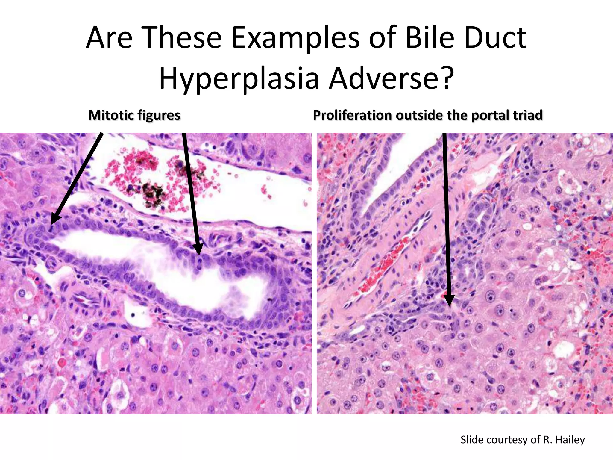 Biliary epithelial hyperplasia:
Adverse?
Mitotic figures Proliferation outside the portal triad
Are These Examples of Bile Duct
Hyperplasia Adverse?
Slide courtesy of R. Hailey
 