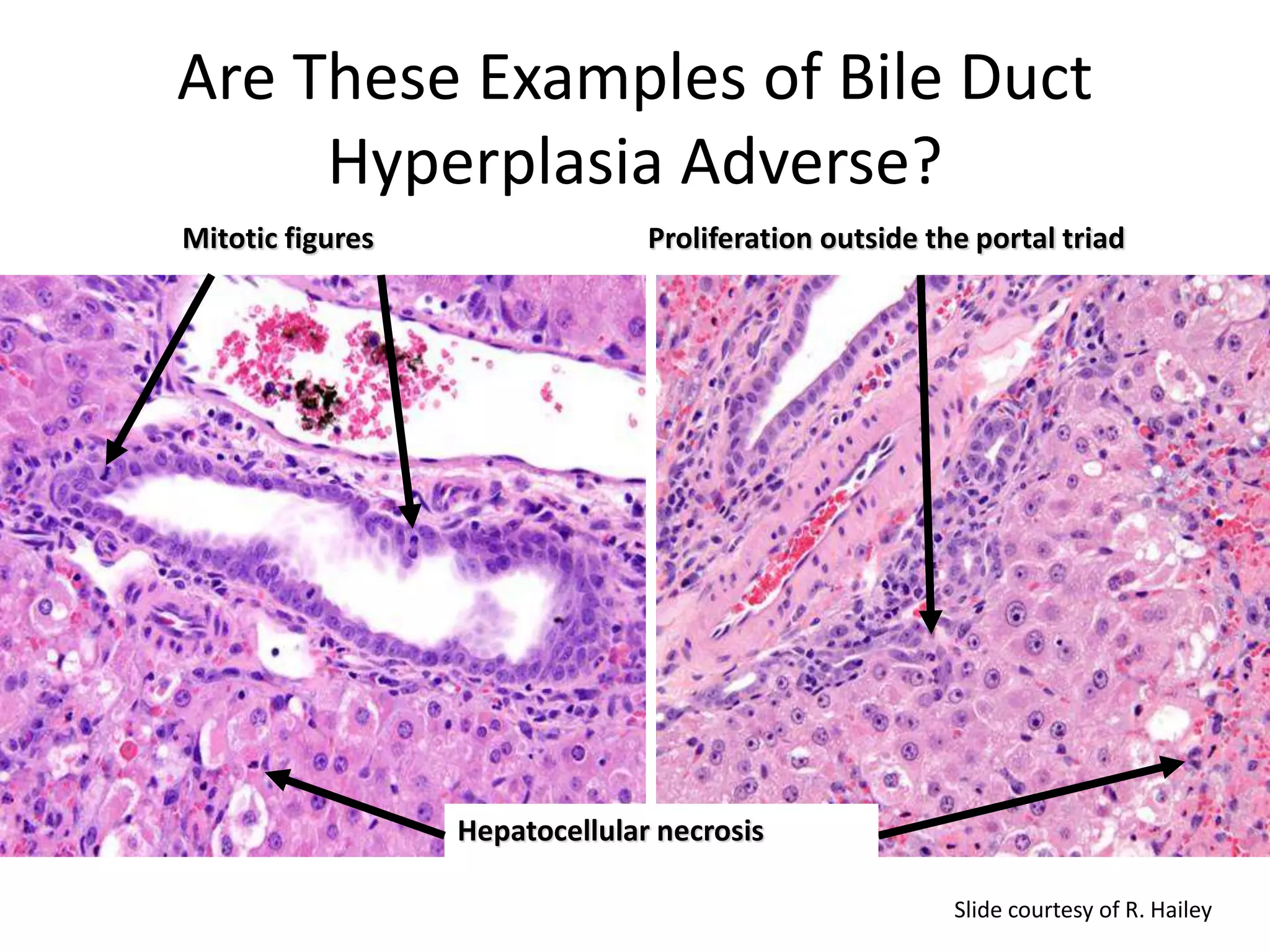Biliary epithelial hyperplasia:
Adverse?
Mitotic figures
Hepatocellular necrosis
Proliferation outside the portal triad
Are These Examples of Bile Duct
Hyperplasia Adverse?
Slide courtesy of R. Hailey
 