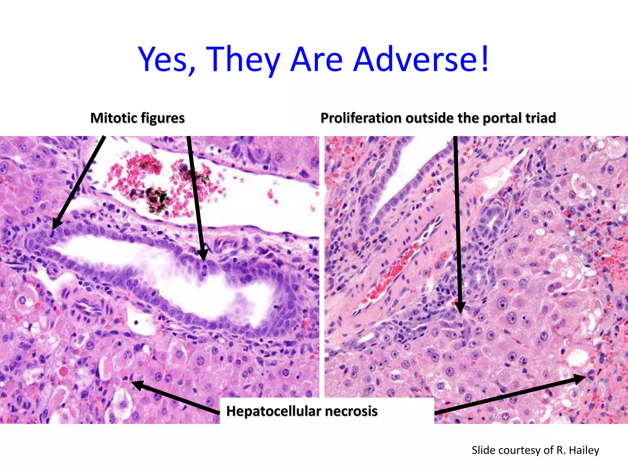 Biliary epithelial hyperplasia:
Adverse?
Mitotic figures
Hepatocellular necrosis
Proliferation outside the portal triad
Yes, They Are Adverse!
Slide courtesy of R. Hailey
 