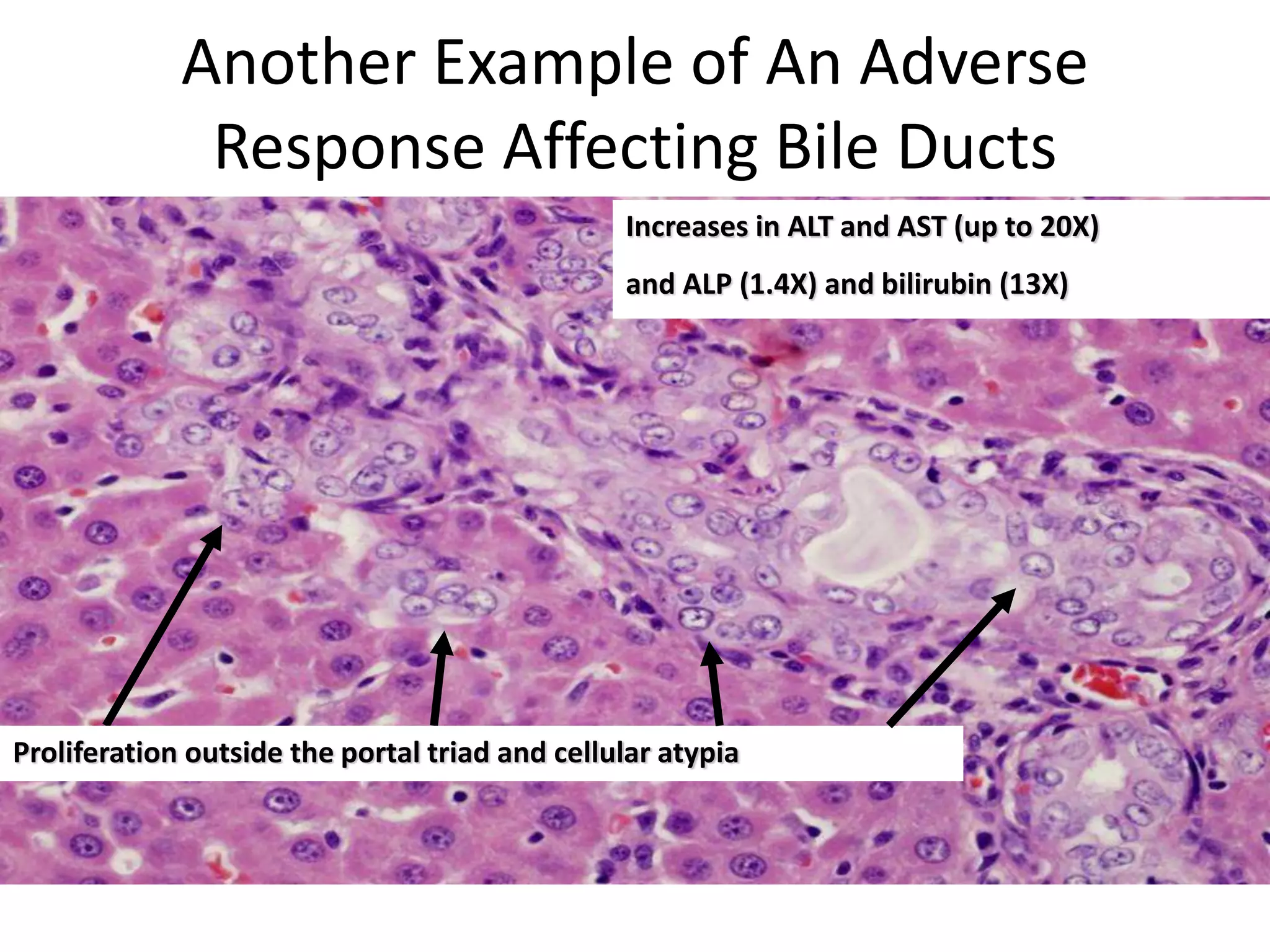 Is this adverse?
Proliferation outside the portal triad and cellular atypia
Increases in ALT and AST (up to 20X)
and ALP (1.4X) and bilirubin (13X)
Another Example of An Adverse
Response Affecting Bile Ducts
 
