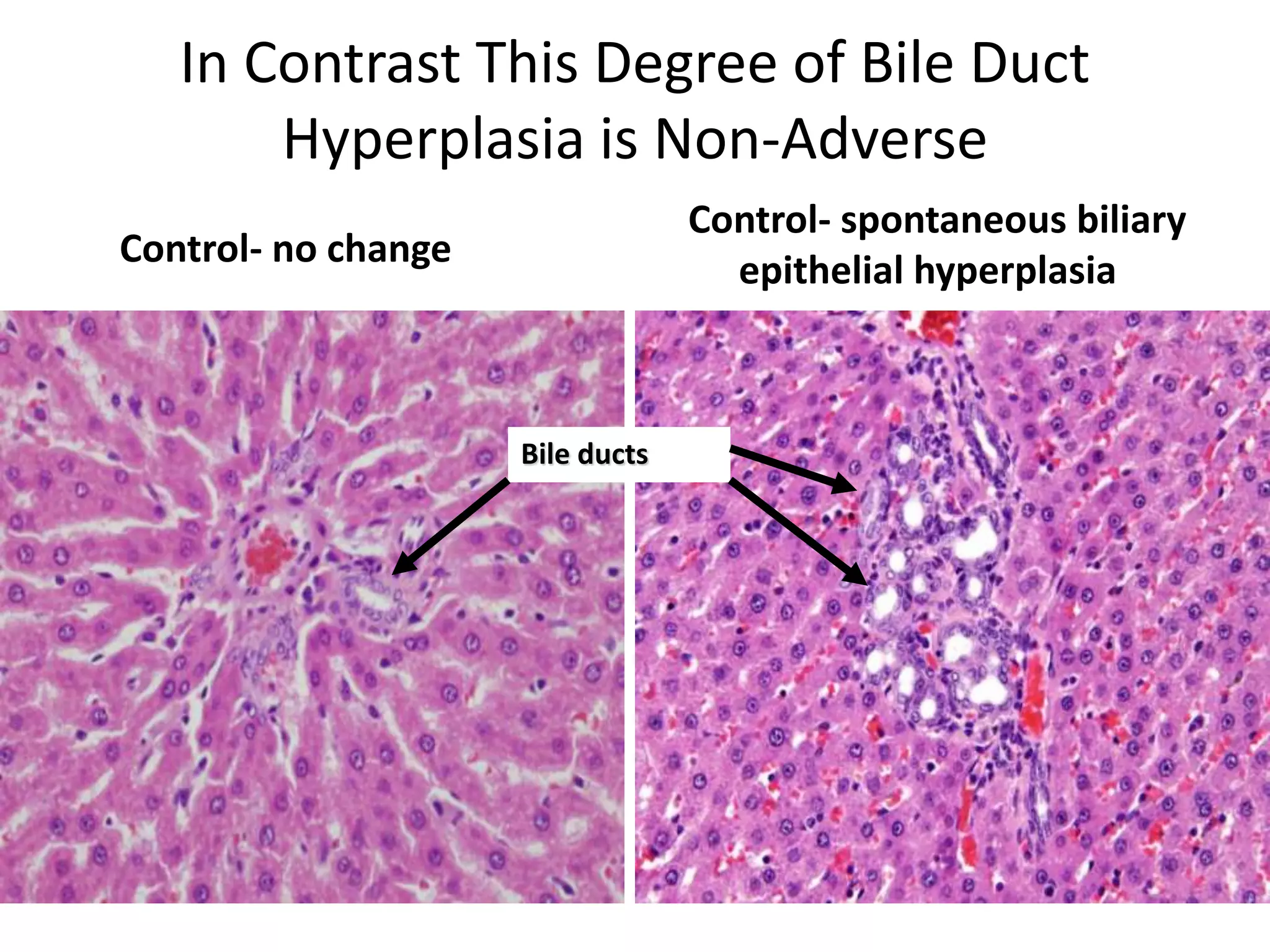 Can Occur Spontaneously
Control- no change
Control- spontaneous biliary
epithelial hyperplasia
Bile ducts
In Contrast This Degree of Bile Duct
Hyperplasia is Non-Adverse
 