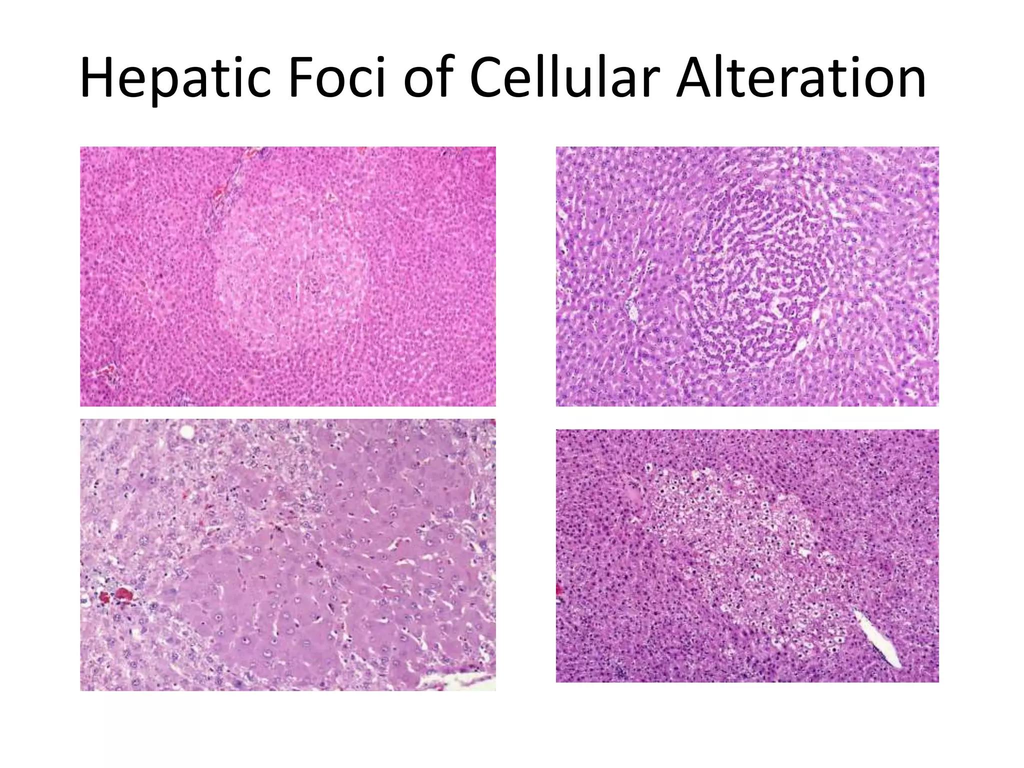 Hepatic Foci of Cellular Alteration
 