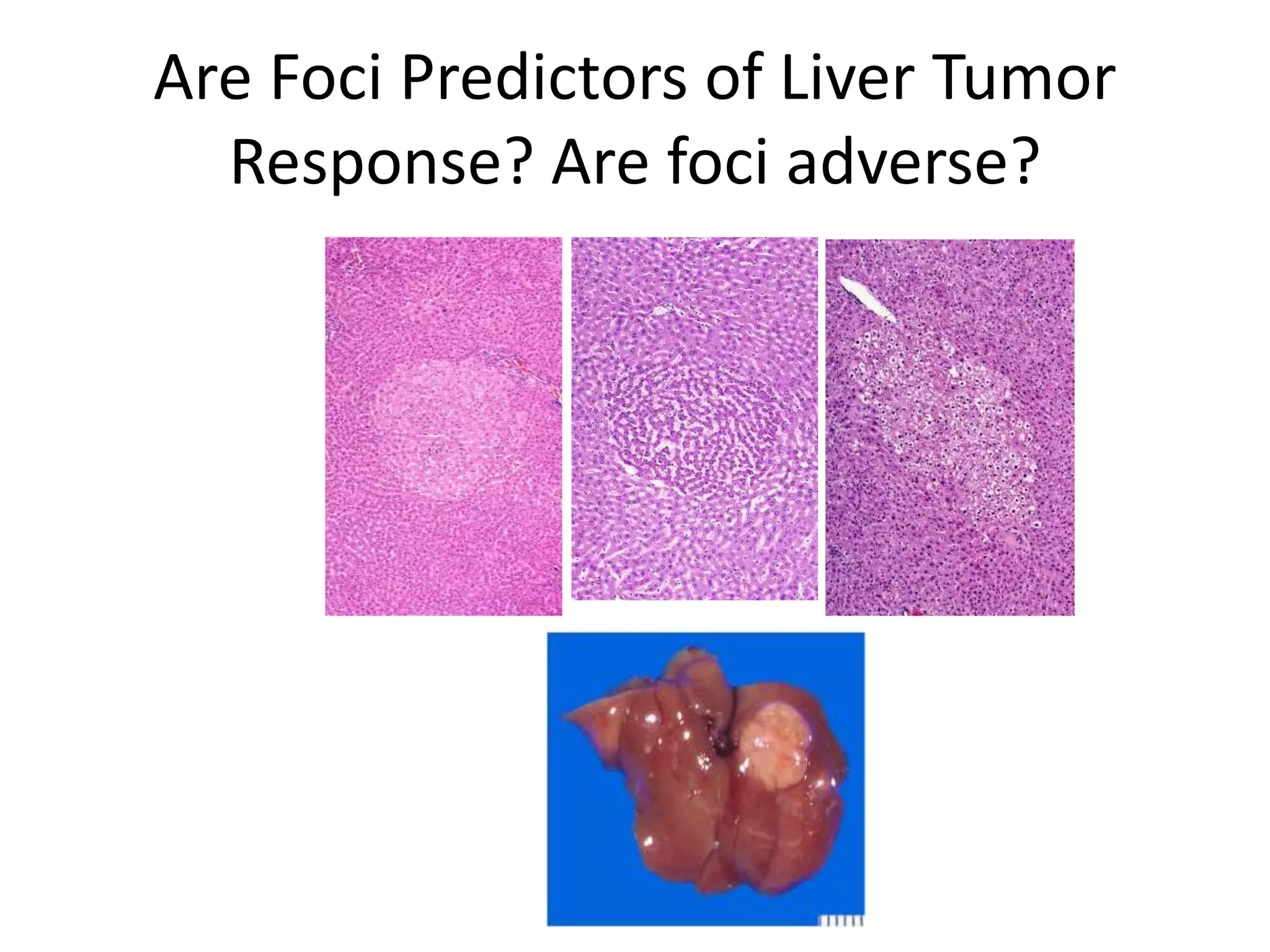 Are Foci Predictors of Liver Tumor
Response? Are foci adverse?
 