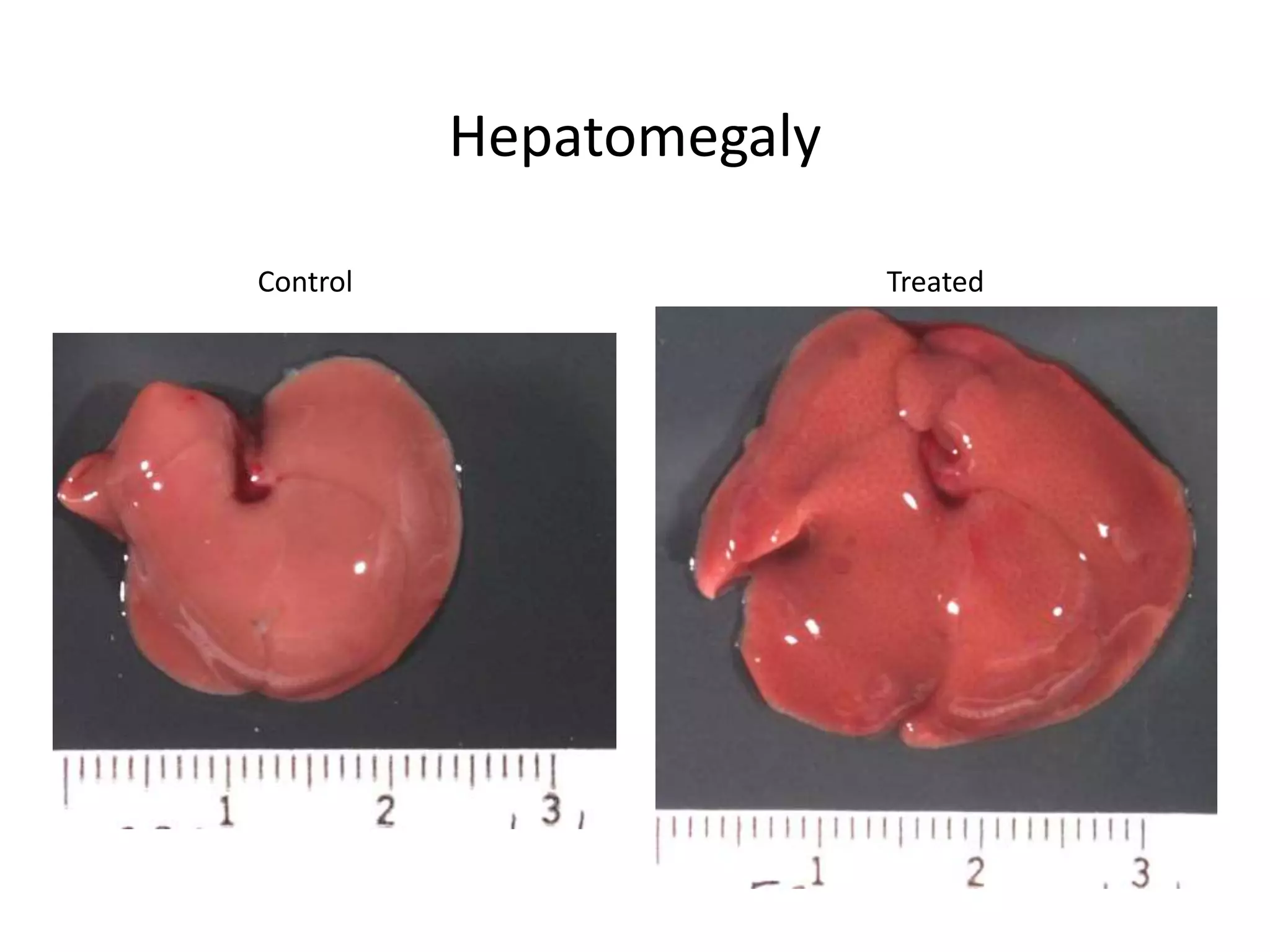 Hepatomegaly
Control Treated
 