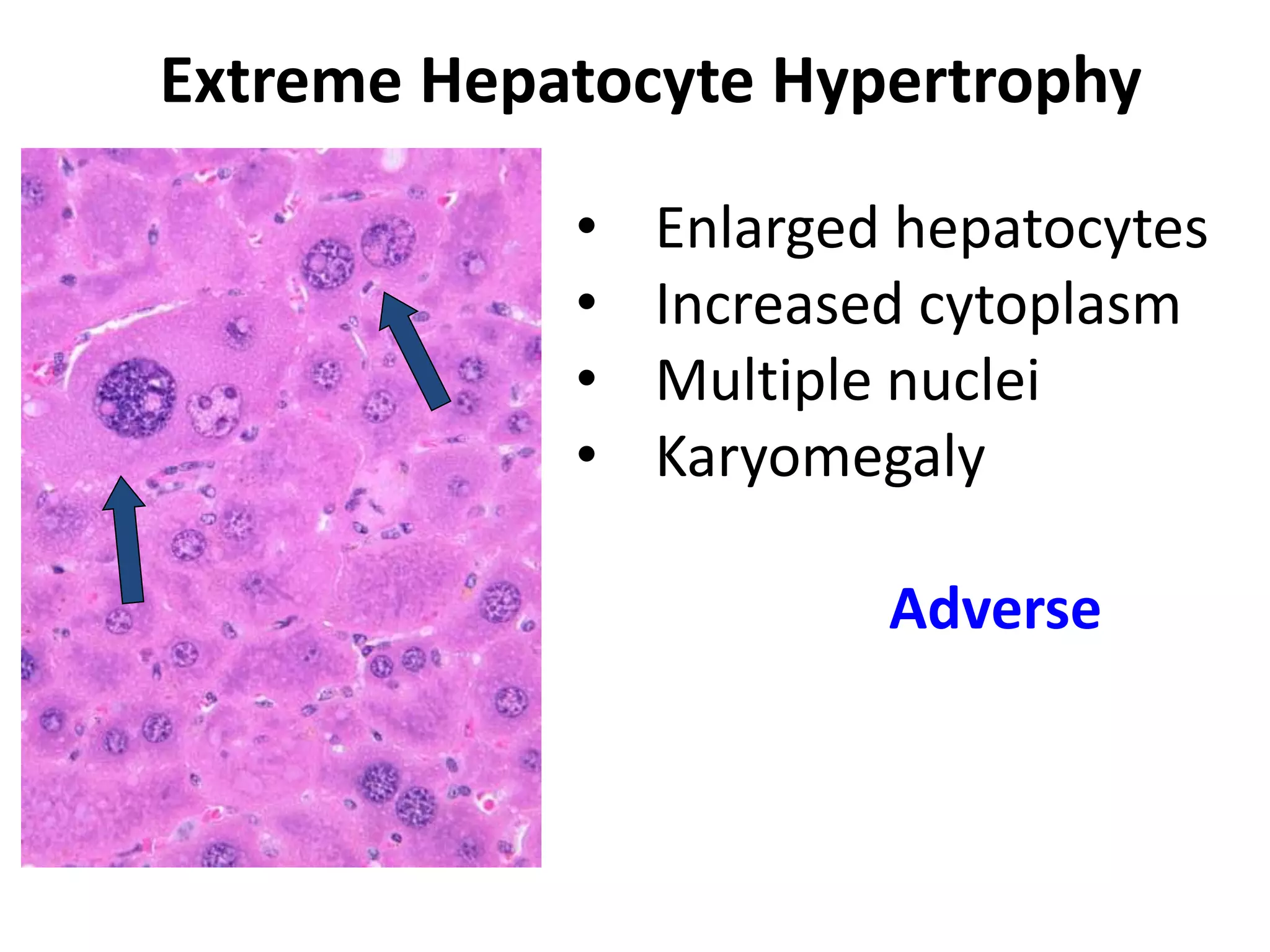 Extreme Hepatocyte Hypertrophy
• Enlarged hepatocytes
• Increased cytoplasm
• Multiple nuclei
• Karyomegaly
Adverse
 