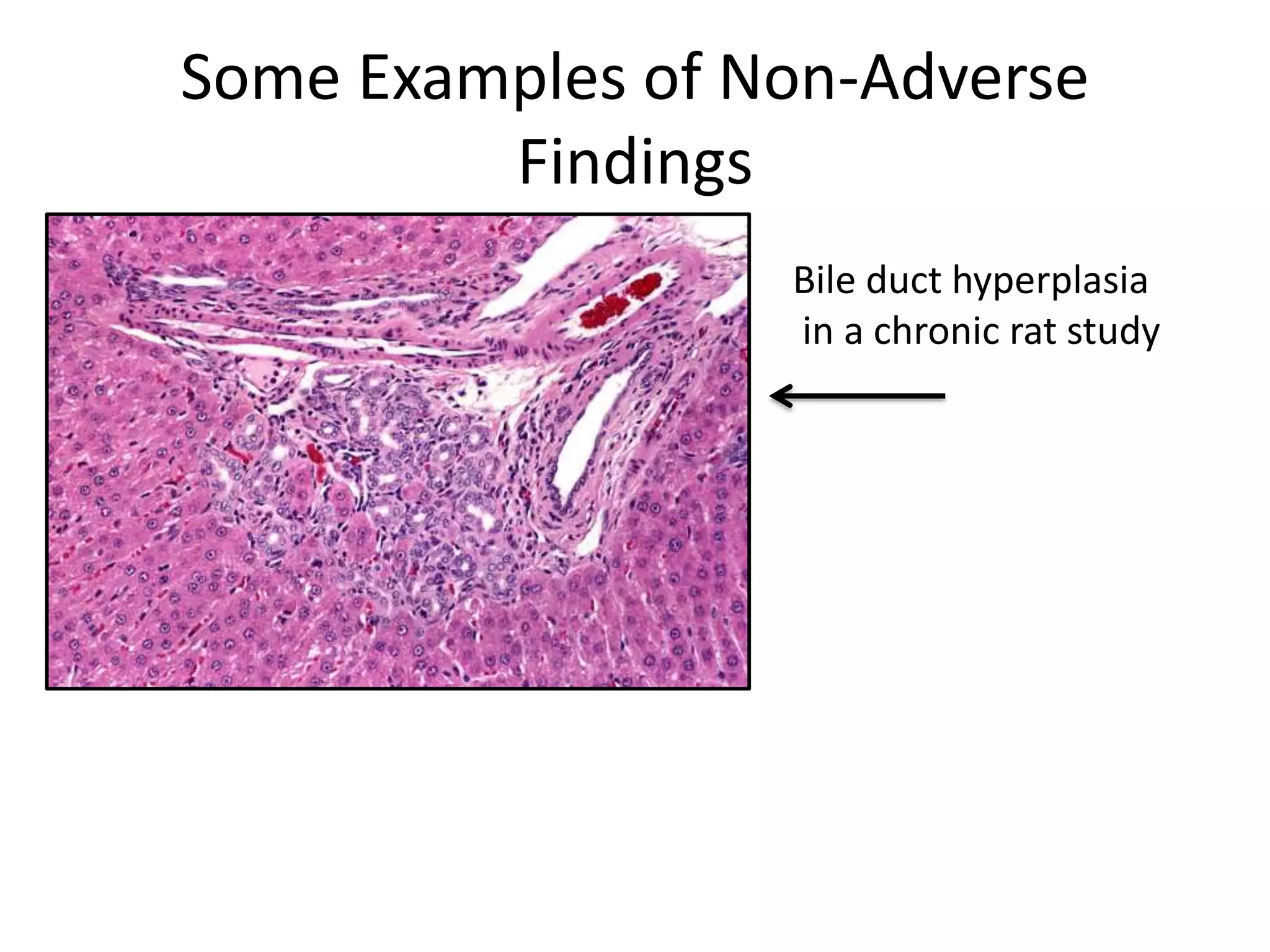 Some Examples of Non-Adverse
Findings
Bile duct hyperplasia
in a chronic rat study
 