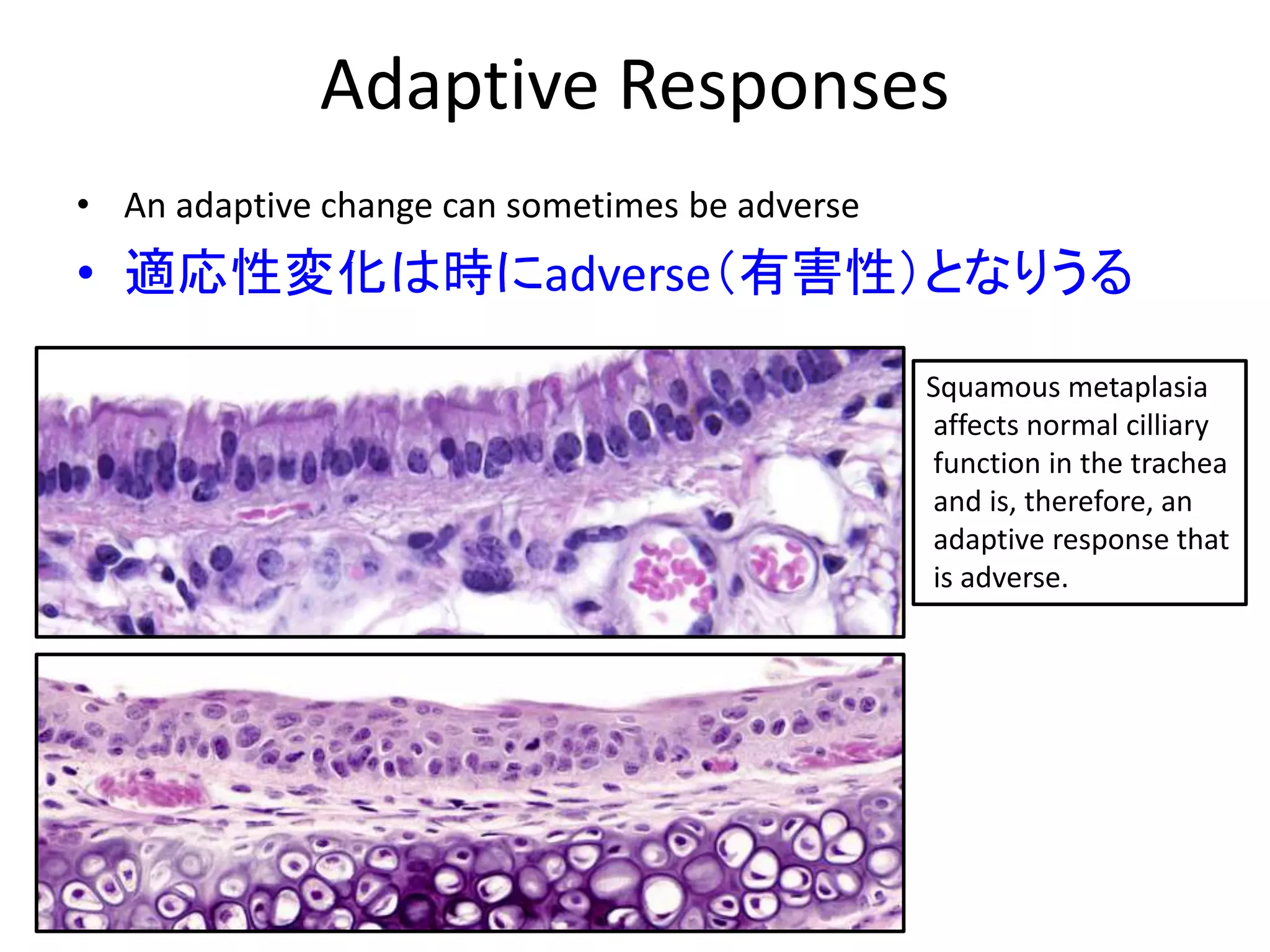 Adaptive Responses
• An adaptive change can sometimes be adverse
• 適応性変化は時にadverse（有害性）となりうる
Squamous metaplasia
affects normal cilliary
function in the trachea
and is, therefore, an
adaptive response that
is adverse.
 