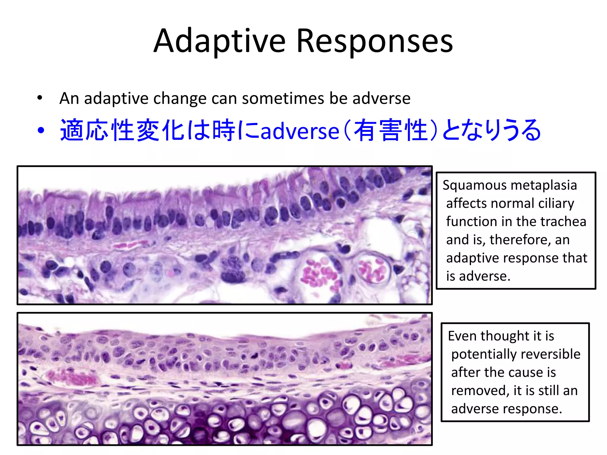 Adaptive Responses
• An adaptive change can sometimes be adverse
• 適応性変化は時にadverse（有害性）となりうる
Squamous metaplasia
affects normal ciliary
function in the trachea
and is, therefore, an
adaptive response that
is adverse.
Even thought it is
potentially reversible
after the cause is
removed, it is still an
adverse response.
 