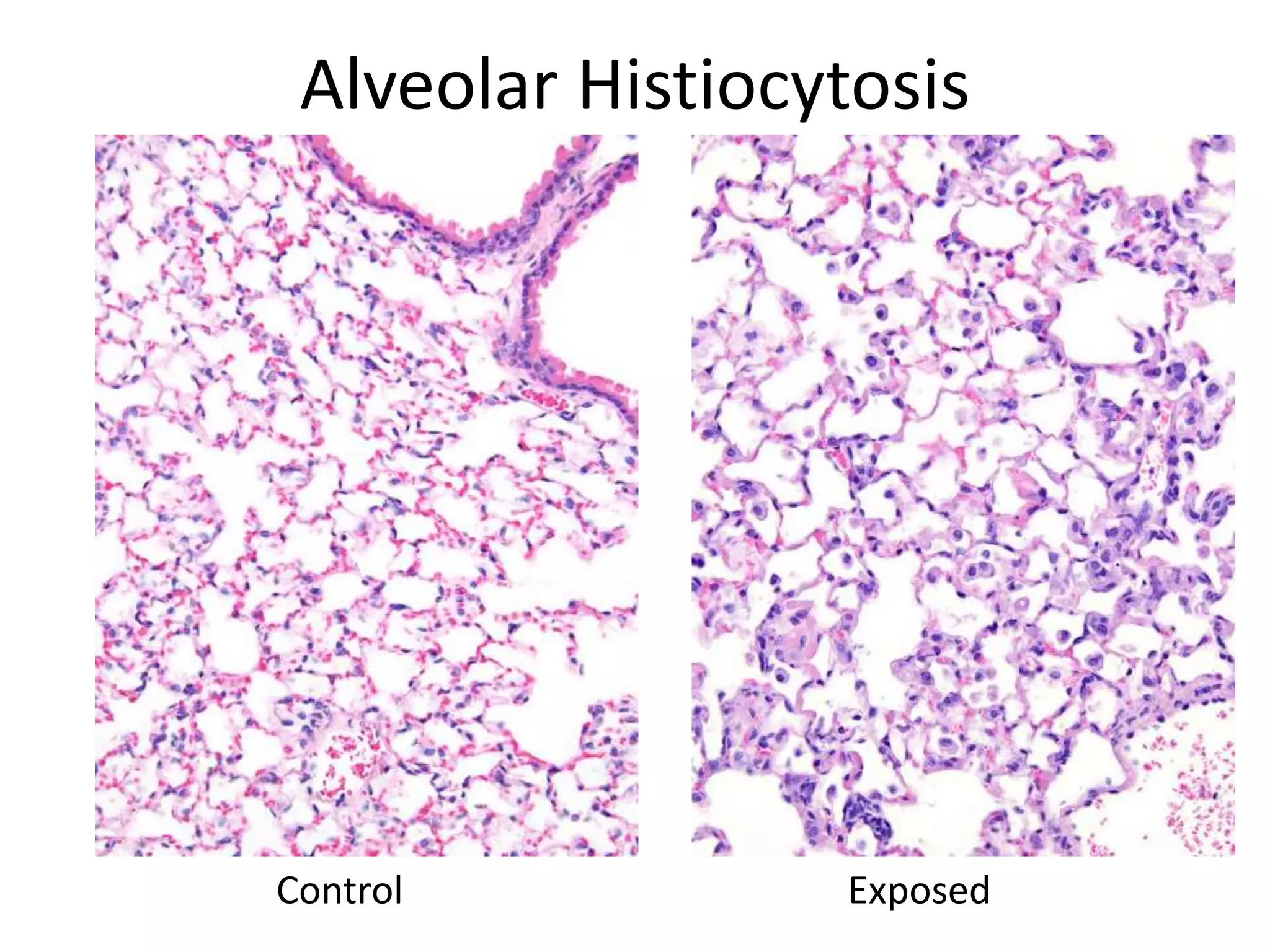 Alveolar Histiocytosis
Control Exposed
 