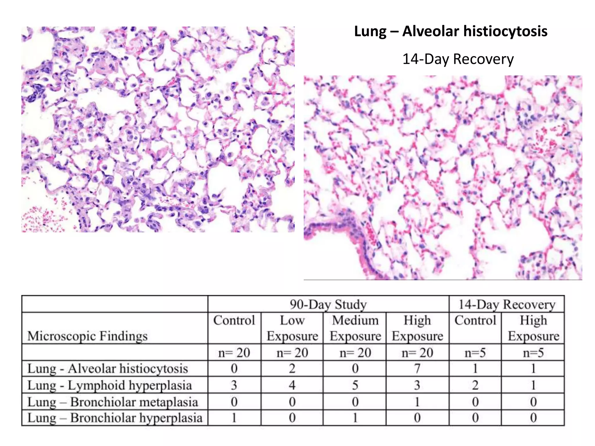 Lung – Alveolar histiocytosis
14-Day Recovery
 