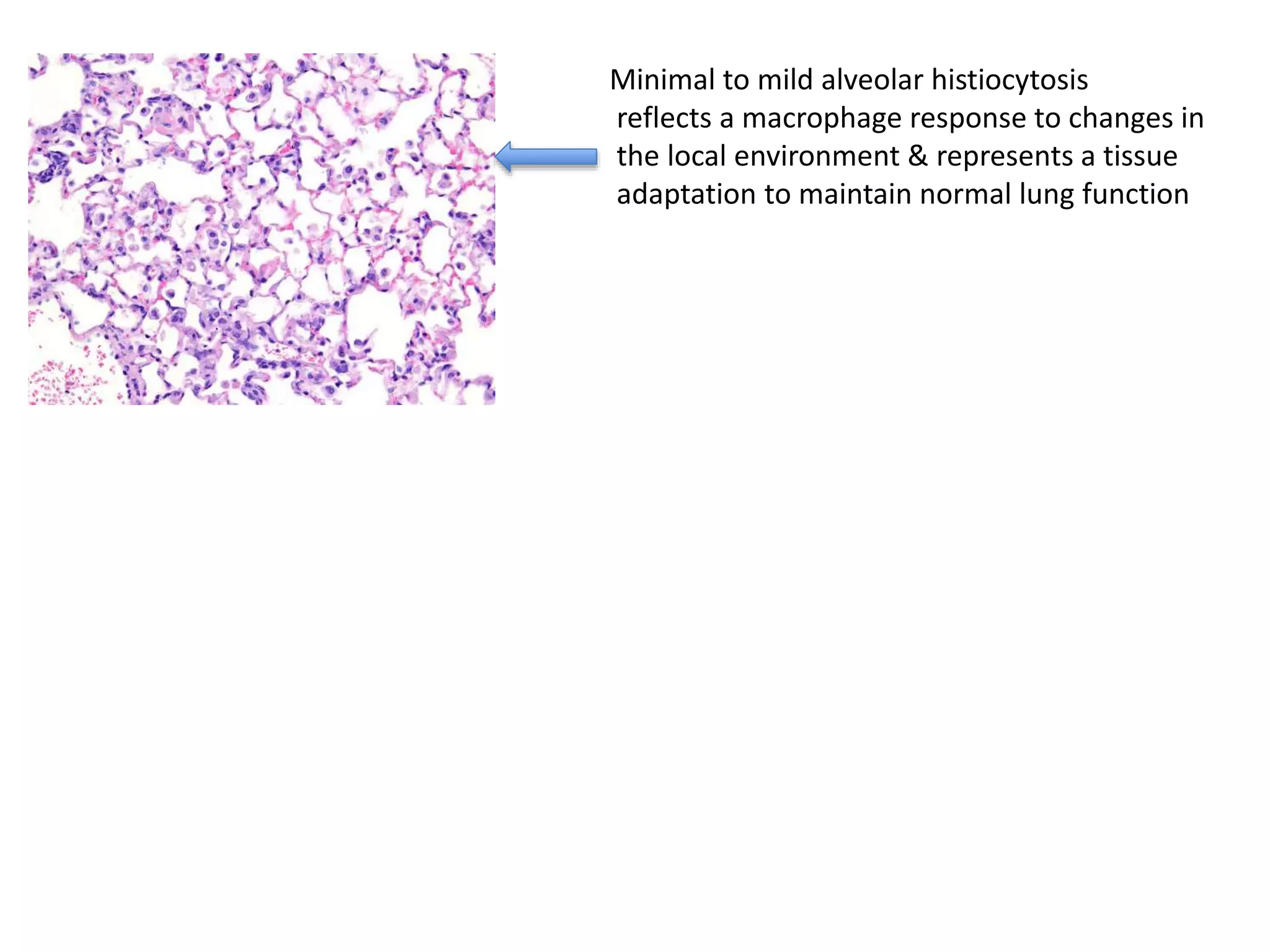 Minimal to mild alveolar histiocytosis
reflects a macrophage response to changes in
the local environment & represents a tissue
adaptation to maintain normal lung function
 