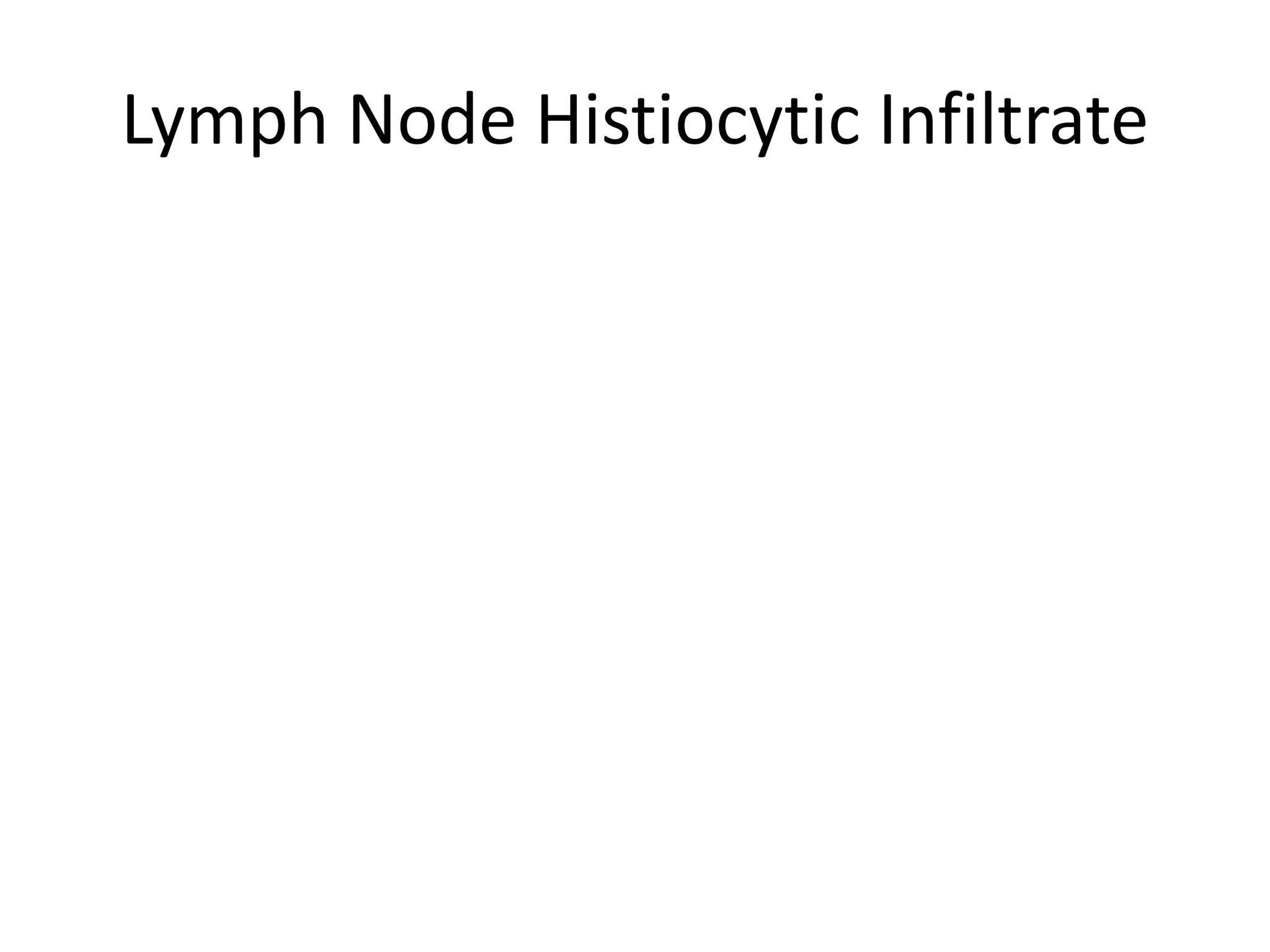 Lymph Node Histiocytic Infiltrate
 