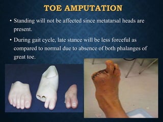 TOE AMPUTATION
• Standing will not be affected since metatarsal heads are
present.
• During gait cycle, late stance will be less forceful as
compared to normal due to absence of both phalanges of
great toe.
11
 