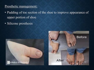Prosthetic management:
• Padding of toe section of the shoe to improve appearance of
upper portion of shoe
• Silicone prosthesis
12
 