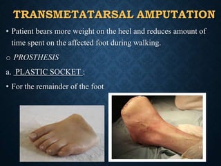 TRANSMETATARSAL AMPUTATION
• Patient bears more weight on the heel and reduces amount of
time spent on the affected foot during walking.
o PROSTHESIS
a. PLASTIC SOCKET :
• For the remainder of the foot
14
 
