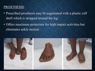 PROSTHESIS:
• Prescribed prosthesis may be augmented with a plastic calf
shell which is strapped around the leg.
• Offers maximum protection for high impact activities but
eliminates ankle motion.
18
 