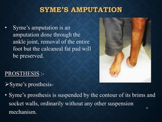 SYME’S AMPUTATION
PROSTHESIS :-
Syme’s prosthesis-
• Syme’s prosthesis is suspended by the contour of its brims and
socket walls, ordinarily without any other suspension
mechanism.
• Syme’s amputation is an
amputation done through the
ankle joint, removal of the entire
foot but the calcaneal fat pad will
be preserved.
19
 