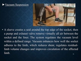 ►Vacuum Suspension
• A sleeve creates a seal around the top edge of the socket, then
a pump and exhaust valve remove virtually all air between the
socket and the liner. The system regulates the vacuum level
within a defined range. Vacuum enhances how well the socket
adheres to the limb, which reduces shear, regulates residual-
limb volume changes and improves circulation of the affected
limb. 35
 