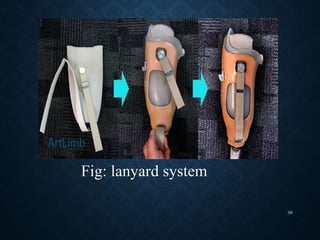Fig: lanyard system
38
 