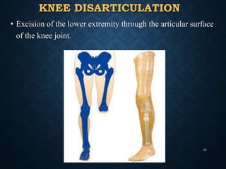KNEE DISARTICULATION
• Excision of the lower extremity through the articular surface
of the knee joint.
45
 