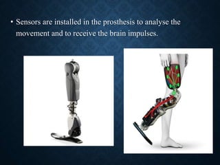 • Sensors are installed in the prosthesis to analyse the
movement and to receive the brain impulses.
47
 