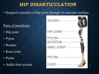 HIP DISARTICULATION
• Surgical resection of hip joint through its articular surface.
Parts of prosthesis:
• Hip joint
• Pylon
• Rotator
• Knee joint
• Pylon
• Ankle foot system 54
 