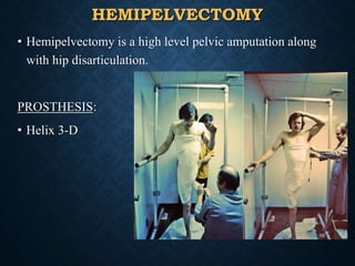 HEMIPELVECTOMY
• Hemipelvectomy is a high level pelvic amputation along
with hip disarticulation.
PROSTHESIS:
• Helix 3-D
59
 