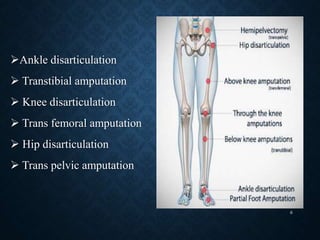 Ankle disarticulation
 Transtibial amputation
 Knee disarticulation
 Trans femoral amputation
 Hip disarticulation
 Trans pelvic amputation
6
 