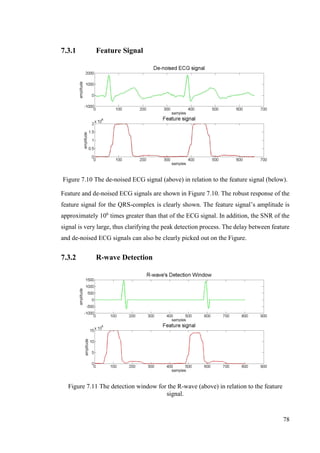 78
7.3.1 Feature Signal
Figure 7.10 The de-noised ECG signal (above) in relation to the feature signal (below).
Feature and de-noised ECG signals are shown in Figure 7.10. The robust response of the
feature signal for the QRS-complex is clearly shown. The feature signal’s amplitude is
approximately 106
times greater than that of the ECG signal. In addition, the SNR of the
signal is very large, thus clarifying the peak detection process. The delay between feature
and de-noised ECG signals can also be clearly picked out on the Figure.
7.3.2 R-wave Detection
Figure 7.11 The detection window for the R-wave (above) in relation to the feature
signal.
 