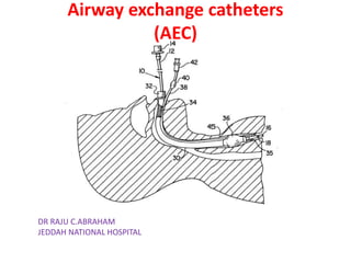 Airway exchange catheters
(AEC)
DR RAJU C.ABRAHAM
JEDDAH NATIONAL HOSPITAL
 