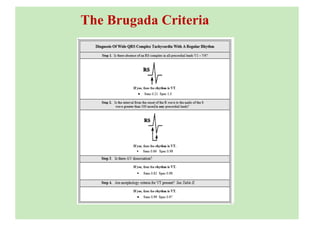 The Brugada Criteria
 