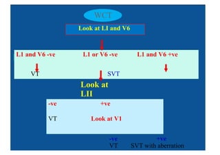 WCT
Look at LI and V6
-ve +ve
VT Look at V1
-ve +ve
VT SVT with aberration
L1 and V6 -ve L1 or V6 -ve L1 and V6 +ve
VT SVT
Look at
LII
 