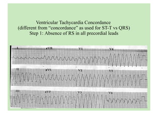 Ventricular Tachycardia Concordance
(different from “concordance” as used for ST-T vs QRS)
Step 1: Absence of RS in all precordial leads
 