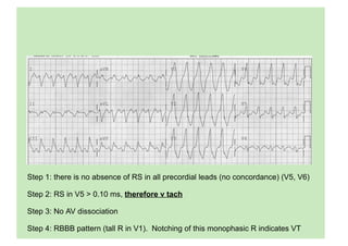 Step 1: there is no absence of RS in all precordial leads (no concordance) (V5, V6)
Step 2: RS in V5 > 0.10 ms, therefore v tach
Step 3: No AV dissociation
Step 4: RBBB pattern (tall R in V1). Notching of this monophasic R indicates VT
 