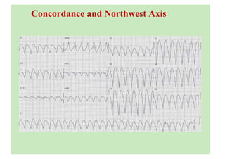 Concordance and Northwest Axis
 