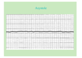 Loading...
Asystole
 