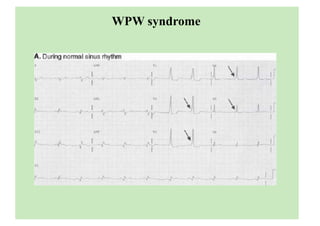 WPW syndrome
 