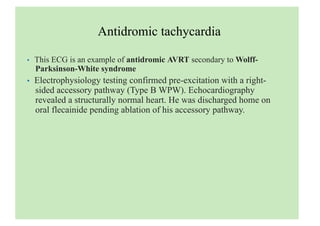 Antidromic tachycardia
• This ECG is an example of antidromic AVRT secondary to Wolff-
Parksinson-White syndrome
• Electrophysiology testing confirmed pre-excitation with a right-
sided accessory pathway (Type B WPW). Echocardiography
revealed a structurally normal heart. He was discharged home on
oral flecainide pending ablation of his accessory pathway.
 