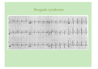 Brugada syndrome
 