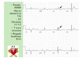 • Pseudo-
RBBB
(but no
slurred S in
V6)
• ST
Elevation
V1-V3
• T wave
inversion
= Brugada
Syndrome
ECG
 