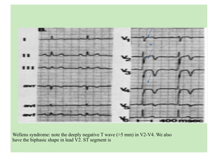 Wellens syndrome: note the deeply negative T wave (>5 mm) in V2-V4. We also
have the biphasic shape in lead V2. ST segment is
 