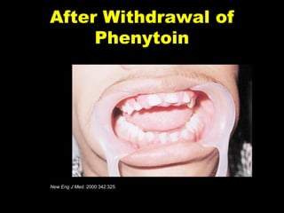 After Withdrawal of
Phenytoin

New Eng J Med. 2000:342:325.

P-Slide 10

 