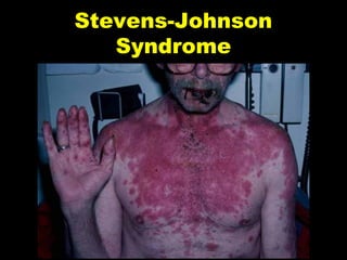Stevens-Johnson
Syndrome

 