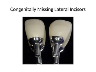Management of Congenitally Missing Bilateral Lateral Incisors with ...