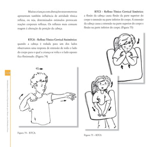 118118
AtendimentoEducacionalEspecializadoparaAlunoscomDeficiênciaFísica
Muitascriançascomalteraçõesneuromotoras
apresentam também influência de atividade tônica
reflexa, ou seja, determinados estímulos provocam
reações corporais reflexas. Os reflexos mais comuns
reagem à alteração da posição da cabeça.
RTCA – Reflexo Tônico Cervical Assimétrico:
quando a cabeça é rodada para um dos lados
observamos uma resposta de extensão de todo o lado
do corpo para o qual a criança se volta e o lado oposto
fica flexionado. (Figura 74)
Figura 74 – RTCA.
RTCS – Reflexo Tônico Cervical Simétrico:
a flexão da cabeça causa flexão da parte superior do
corpo e extensão na parte inferior do corpo. A extensão
da cabeça causa a extensão na parte superior do corpo e
flexão na parte inferior do corpo. (Figura 75)
Figura 75 – RTCS.
 