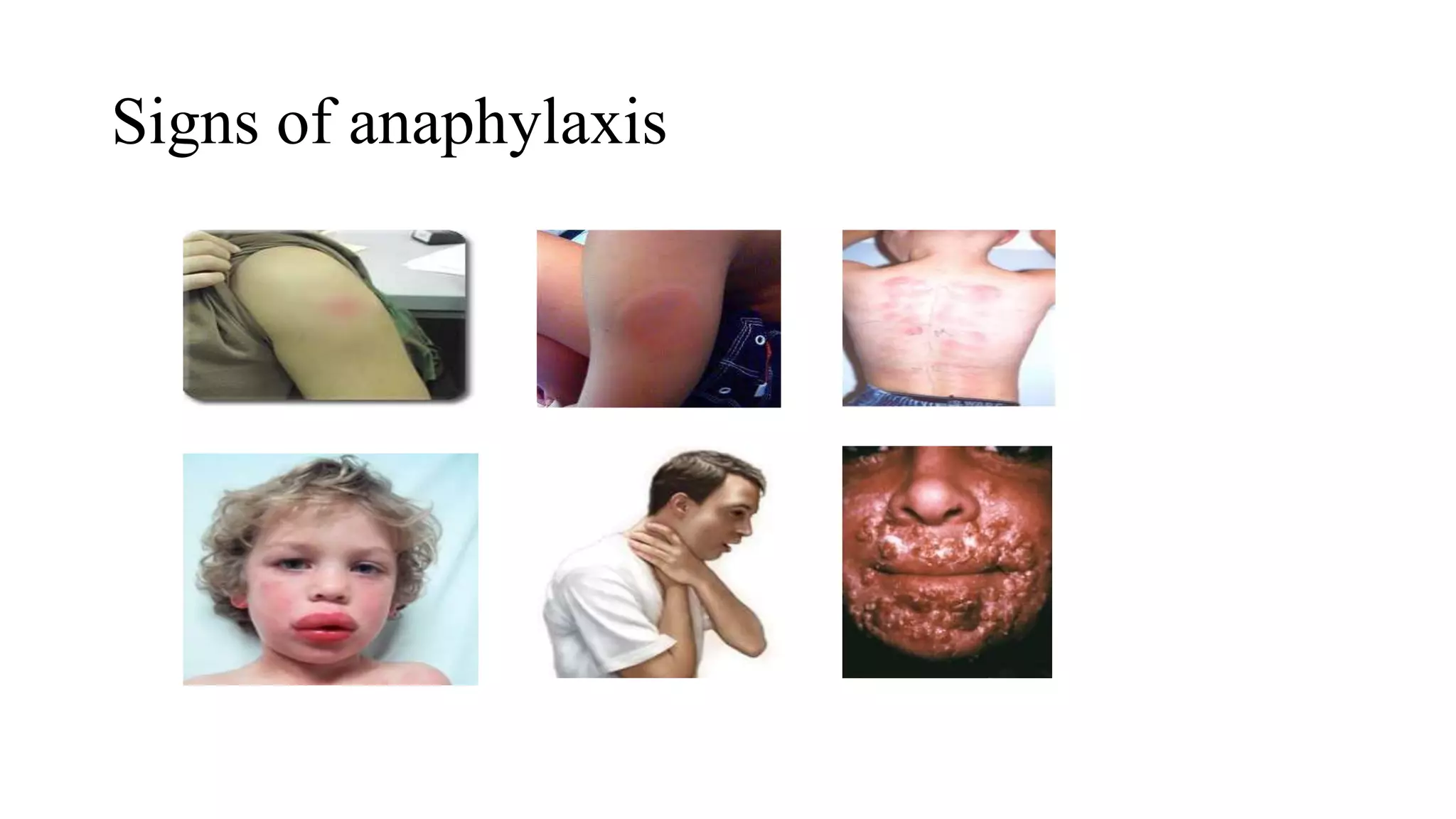 Signs of anaphylaxis
 